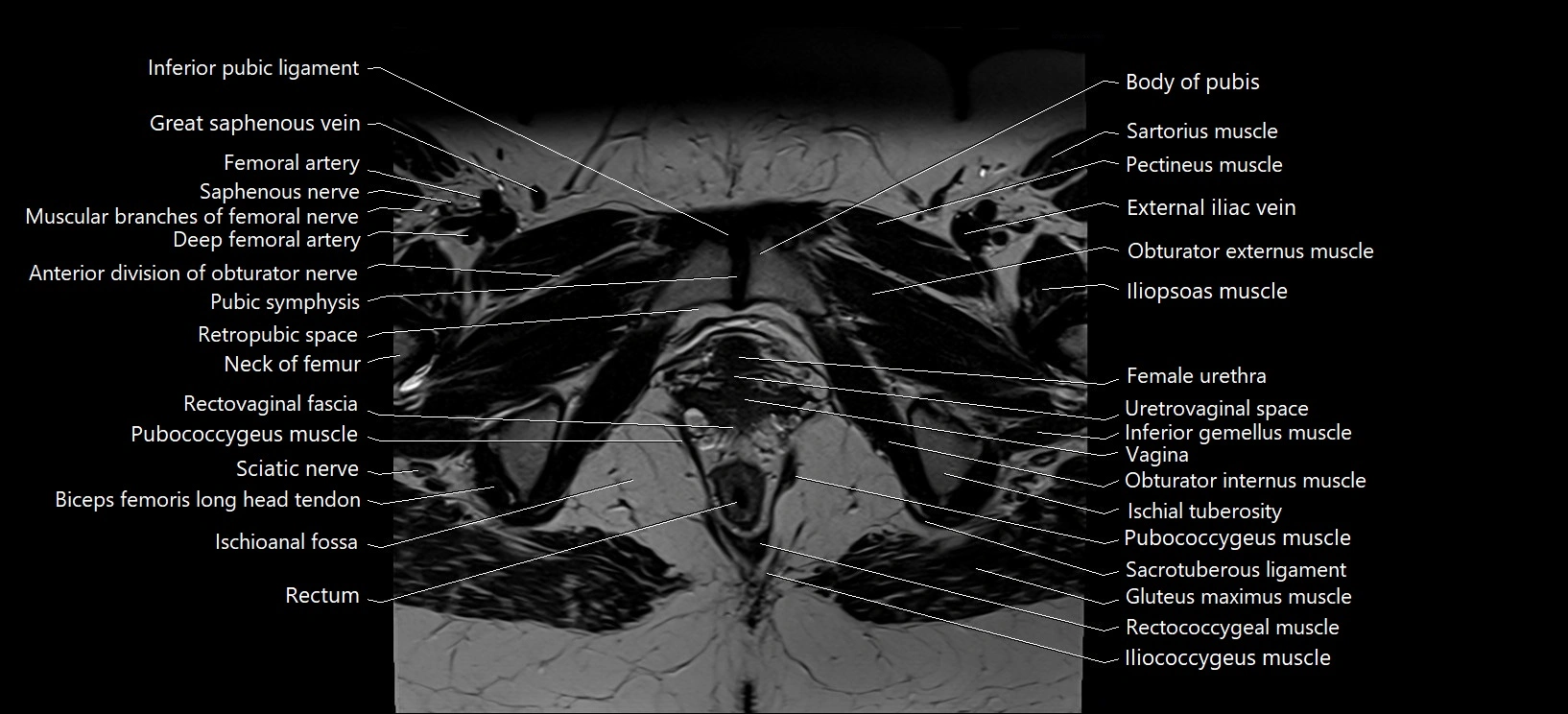 Axial cross sectional anatomy of female pelvis (MRI 3T) image 35.webp